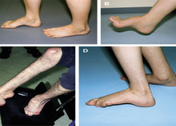 How severe is the pereira foot injury? Get all the details about his condition now.